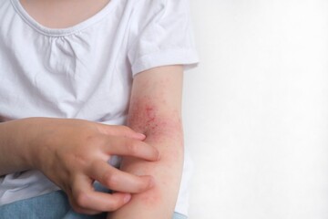 The child scratches atopic skin. Dermatitis, diathesis, allergy on the child's body.