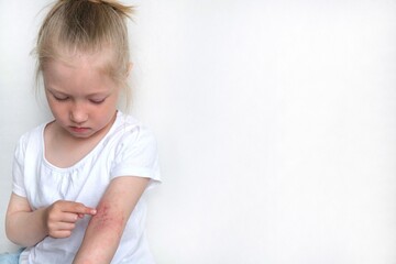 The child scratches atopic skin. Dermatitis, diathesis, allergy on the child's body.