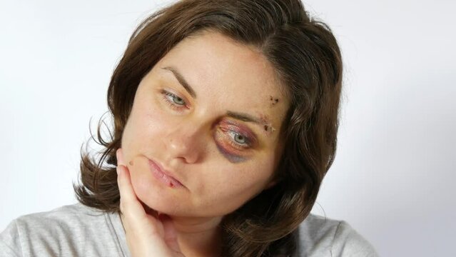 Large real bruise hematoma under eye of young woman, purple bruise. Broken lip and forehead wound. terrified face of domestic violence victim. Woman looks thoughtfully, resting her chin in her hand