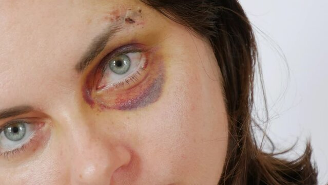 Large real bruise hematoma under the eye of a young woman, purple bruise. Broken lip and forehead wound. terrified face of domestic violence victim close-up white background.