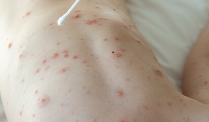 little baby boy with severe form of varicella,chickenpox virus.father holding cotton swab.lot of blisters on child body.nettle rash spread over the all body,most of them in shoulder,neck and hands