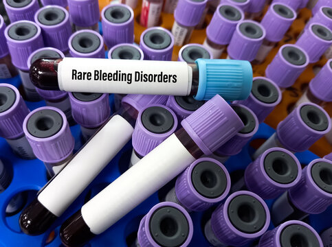 Blood sample for Rare Bleeding Disorders(RBDs) test, factor XI test, FXI, factor XI deficiency test, test for hemophilia C, Coagulation disorders.