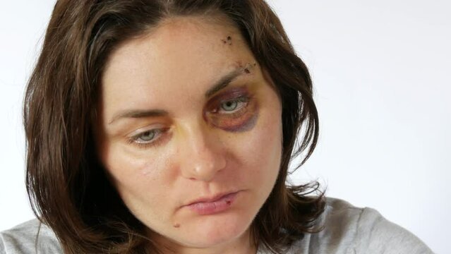 Large real bruise hematoma under the eye of a young woman, purple bruise. Broken lip and forehead wound. terrified face of domestic violence victim close-up white background.