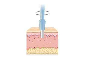 Turn the medical instrument and cut down to the skin layer to get sample tissue. Illustration about Biopsy punches for medical diagnosis and skin cancer treatment.