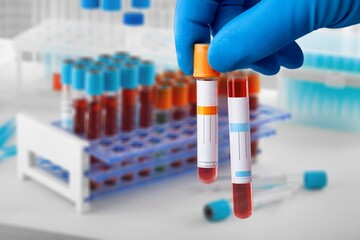 Blood samples of patient for test in laboratory. Blood tubes