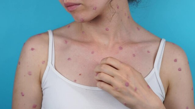 Infected woman streches monkeypox itchy rash on body