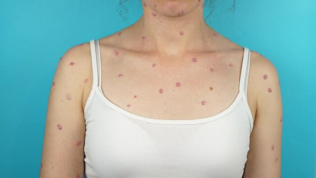 Monkeypox rash on woman's body, blue background