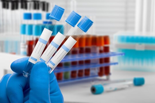 Blood sample of patient for complete screening test in laboratory. doctor with Blood tube and catheter