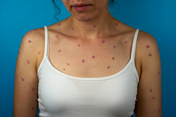 Itchy rash on woman's body infected by monkeypox virus