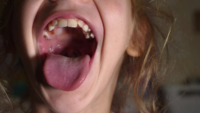 The child shows her teeth and soft palate, opening her mouth wide. The tongue is stuck out as far as possible. Close-up