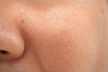Asian male nose and cheek close up has skin problem, large pores, whitehead and blackhead pimple. Pores on the face of a man. - obrazy, fototapety, plakaty