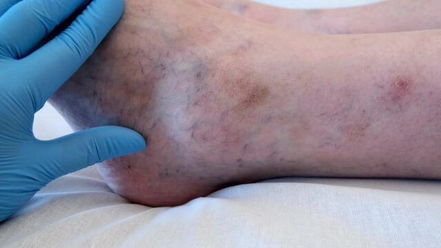 Varicose veins on a male leg. 4K footage