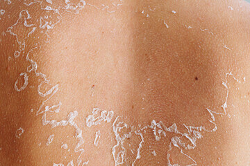 Cracked skin on back will peel off in pieces on female body