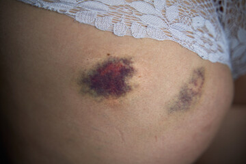 Injury on the skin after a fall. Hematoma on a woman's buttock.