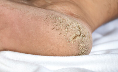 Close up cracked heel further deep cracks and dry flaky skin
