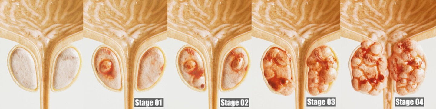 Prostate cancer all 4 stages - detailed close-up - 3D rendering