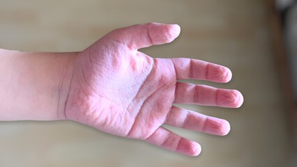 The photo palm child of three years , which wrinkled and shriveled due to the long stay in the...