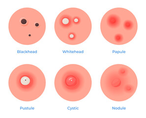 Different types of skin problems. Pimples, black spots, acne. Skin care. Vector illustration
