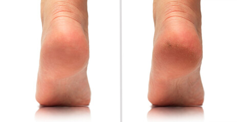 Image before and after feet dry skin cracked heel treatment. Cracked heels before and after...
