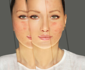 Acne,Skin concern,blemish-prone skin and acne, Rosacea,different types of acne