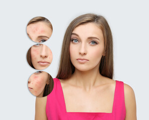 Obraz na płótnie Canvas Acne,Skin concern,blemish-prone skin and acne, Rosacea,different types of acne