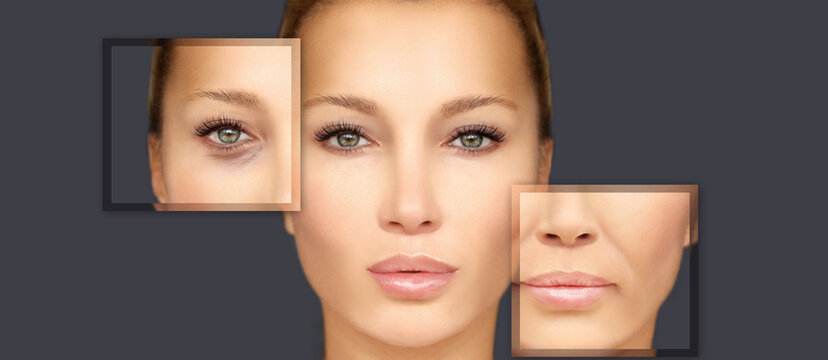 Effects of ageing,Frownscowl lines ,Nasolabial folds,Neck ,Under eye circles,neck lines. Plastic Surgery Results