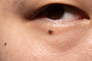 mole under the eyes of a man, pigmentation on the face