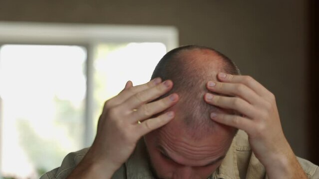 Unhappy man checking his hairstyle in the mirror looks at the bald spot on his head, hair loss. 