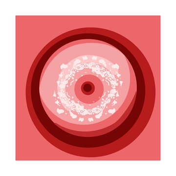 Cervical cancer Dysplasia CIN 1 stage infographic Female reproductive system Carcinoma uterus speculum view cervix. Human medical anatomy internal organs location scheme flat style icon isolated