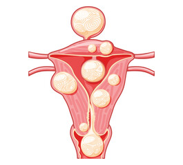 Set of Uterine fibroids Female leiomyomas reproductive system uterus in different styles and cross sections. Front view in a cut. Human anatomy medical illustration isolated internal organs flat icon
