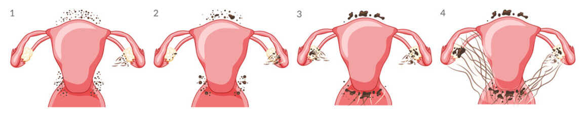 Set of Endometriosis 4 stages Female reproductive system pain cancer cyst uterus. Human anatomy internal organs location scheme flat style icon vector illustration Realistic concept isolated on white