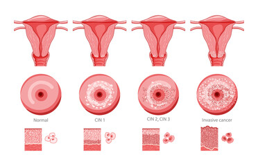 Set of Cervical invasive cancer intraepithelial neoplasia Dysplasia 1 2,3 and normal stage cell morphology on pap smear test infographic Female reproductive system Carcinoma view. medical flat style