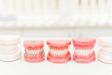 Set of 5 model teeth displaying different orthodontic devices