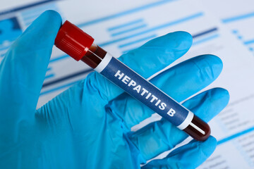 Scientist holding tube with blood sample and label Hepatitis B against laboratory test form, closeup