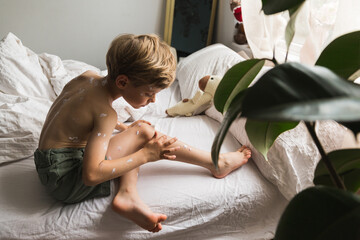 young boy got chicken pox infection pandemic