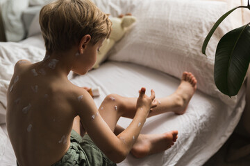 young boy got chicken pox infection pandemic