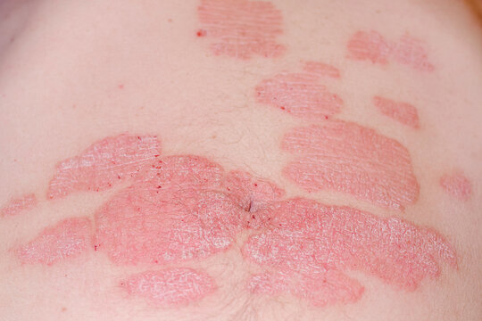 Acute psoriasis on the stomach in a man, severe redness on the skin, an autoimmune incurable dermatological skin disease. Red redness, spots on the skin.Large red inflamed scaly rash on the stomach.
