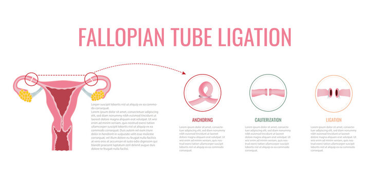 Fallopian tube ligation. types of tubal ligation on white background. surgical procedure. flat vector.