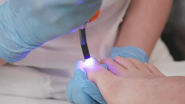 Professional chiropodist installs a titanium thread on the big toe and using UV gadget. Correction of ingrown toenail. The concept of podology, orthopedics and chiropody.