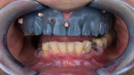 removable mock-up of the future prosthesis of the upper jaw in the oral cavity