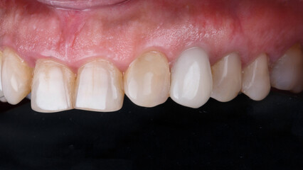 installed dental crown after implantation in the molar area