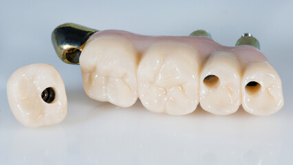 zircon bridge prosthesis on a bar and a single crown on a white background