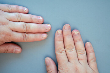 Onychomycosis fungal infection of the nail. It is the most common disease of the nails. It is an...