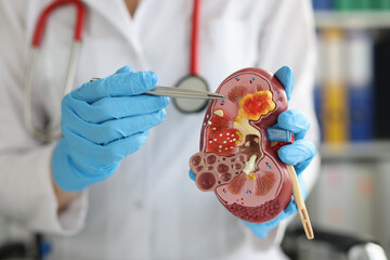 Urology and treatment of kidney diseases closeup