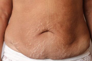 Close up of woman's belly with stretch mark loose lower abdomen skin she fat after pregnancy baby...