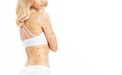 Woman is infected with monkeypox. Skin rash, pimples, acne and boils on the back. Pandemic, virus infection, vaccination and healthcare concept.