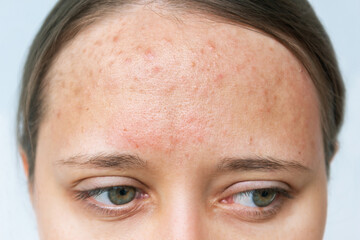Close up of red rash on a forehead. Cropped shot of a young woman's face with acne problem....