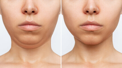 Liposuction of the double chin. Cropped shot of a woman's face with chin before and after cosmetic plastic surgery isolated on a white background. The result of lifting, fat removal, weight loss - obrazy, fototapety, plakaty