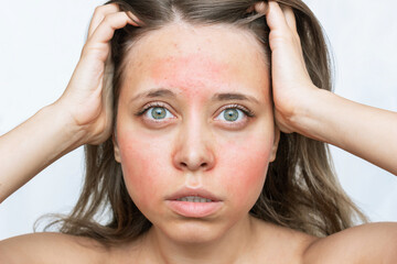 A young caucasian worried woman with a red allergic rash on her cheeks and forehead isolated on white background. Allergy on the face. Allergic reaction to food, cosmetics, medicines  - obrazy, fototapety, plakaty
