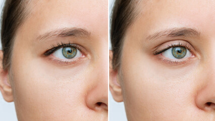 Cropped shot of a young caucasian woman's face with drooping upper eyelid before and after...